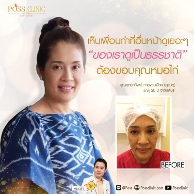 ร้อยไหมหน้าเด็ก