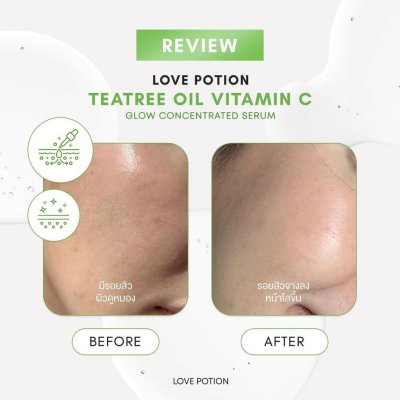 (ใช้โค้ดเหลือ 89.-) LovePotion Acne serum love 10ml (ขวดเล็ก) แพ็คเก็จใหม่ เลิฟโพชั่น เซรั่มเลิฟ