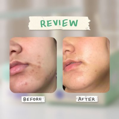 LovePotion Cactus Cream Intense Spot / BHA (30g) เลิฟ โพชั่น ครีมแคคตัส ลดรอยสิว