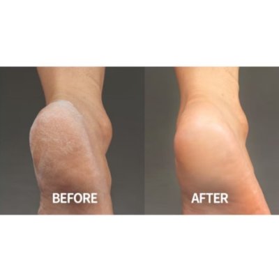 Baren Foot Softener At-Home Kit (100ml +  Foot File ขัดเท้า) บาเรน ชุดขจัดเซลล์ผิวตายส้นเท้า