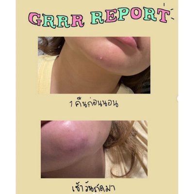 Grrrbeauty Star Catcher Grrr Hydrocolloid Acne Patches (2 แผ่น 24 ชิ้น) เกอบิวตี้ แผ่นแปะสิว ลายดาว