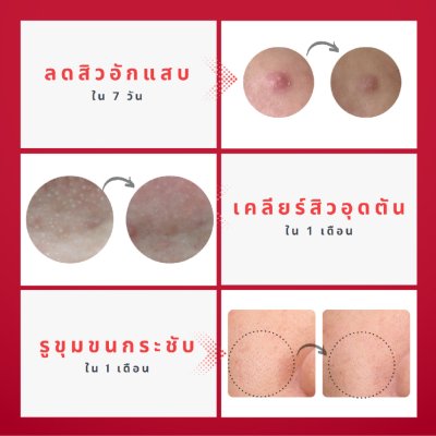 Zeroid Pimprove Anti - Blemish & Pore Clarifying Serum (40ml) ซีรอย เซรั่ม เซรั่มจบปัญหาสิว