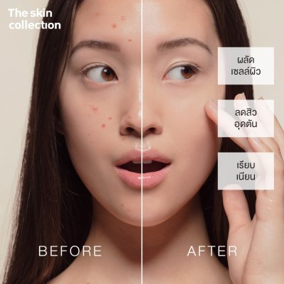 The Skin Collection Serum AHA10% + BHA2% (30ml) เซรั่มช่วยผลัดเซลล์ผิว แก้ปัญหาสิวอุดตัน