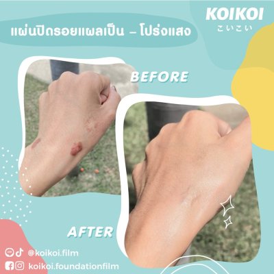 KOIKOI Foundation Film - Scar แผ่นฟิล์มสำหรับปกปิดรอยแผลเป็น พรางรอยแผลเป็นได้เนียนกริบ