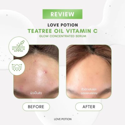 (ใช้โค้ดเหลือ 89.-) LovePotion Acne serum love 10ml (ขวดเล็ก) แพ็คเก็จใหม่ เลิฟโพชั่น เซรั่มเลิฟ