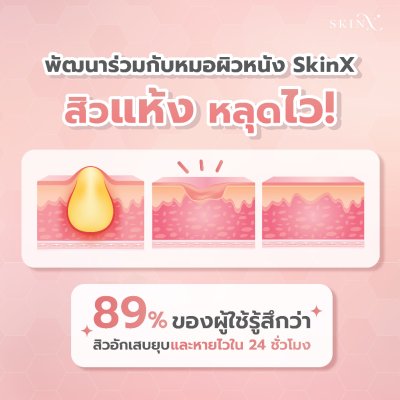 SkinX Lotion-PX Anti Acne Cream (10g) สกินเอ็กซ์ ครีมแต้มสิว