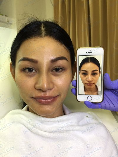 ผิวเรียบเนียน ปราศจากขนด้วย เลเซอร์กำจัดขน USA CoolGlide® CUTERA (Laser Hair Removal)