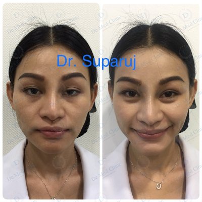 ผิวเรียบเนียน ปราศจากขนด้วย เลเซอร์กำจัดขน USA CoolGlide® CUTERA (Laser Hair Removal)