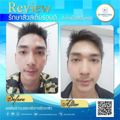 Review Picosecond Laser รักษาหลุมสิว ช่วยดูแลการเกิดแผลเป็นนูน Hypertrophic scar หรือ Keloid หลังจากการผ่าตัด