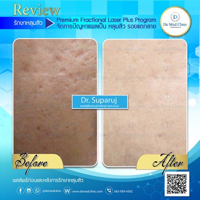 Review Picosecond Laser รักษาหลุมสิว ช่วยดูแลการเกิดแผลเป็นนูน Hypertrophic scar หรือ Keloid หลังจากการผ่าตัด
