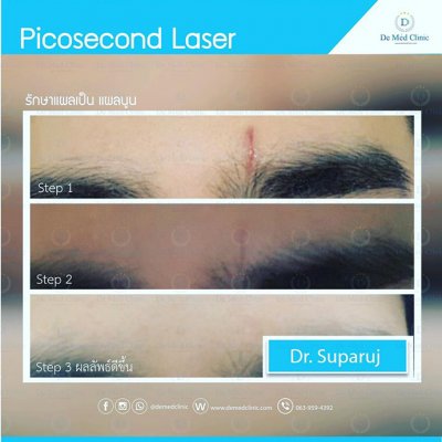 Review ผลการรักษาด้วยโปรแกรม Picosecond Laser  และโปรแกรมต่างๆ และ ผู้ใช้บริการที่ DeMed Clinic