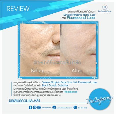 Picosecond Laser ช่วยดูแล หลุมสิว การเกิดแผลเป็นนูน Hypertrophic scar หรือ Keloid หลังจากการผ่าตัด