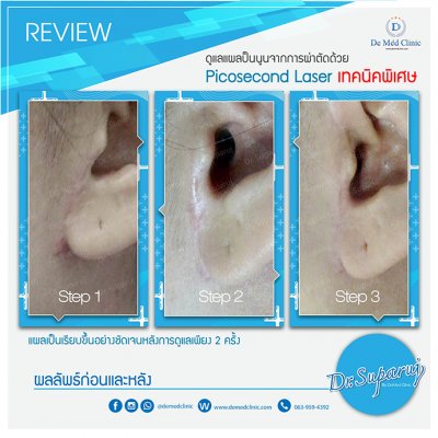 Picosecond Laser ช่วยดูแล หลุมสิว การเกิดแผลเป็นนูน Hypertrophic scar หรือ Keloid หลังจากการผ่าตัด
