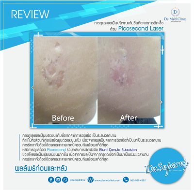 Picosecond Laser ช่วยดูแล หลุมสิว การเกิดแผลเป็นนูน Hypertrophic scar หรือ Keloid หลังจากการผ่าตัด