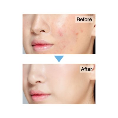 Clear Nose Acne Care Solution Concealer