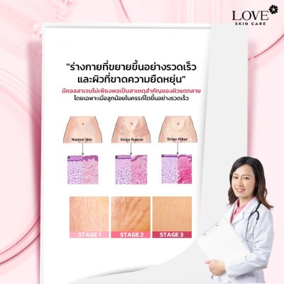 Stretch Marks Cream ครีมลดรอยแตกลาย ป้องกันผิวแตกลาย สูตรแพทย์