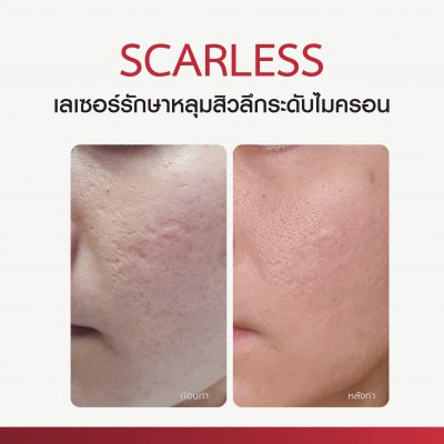 Scarless MCL31