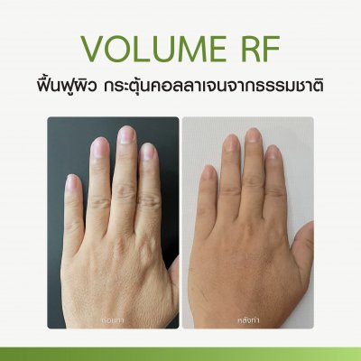 Review Volume RF Lift