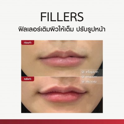 Review Fillers
