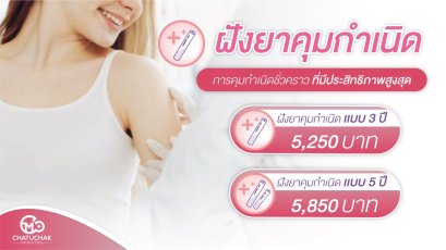 ยาฝังคุมกำเนิดแบบ 3 ปี และ 5 ปี | CMC Wellness