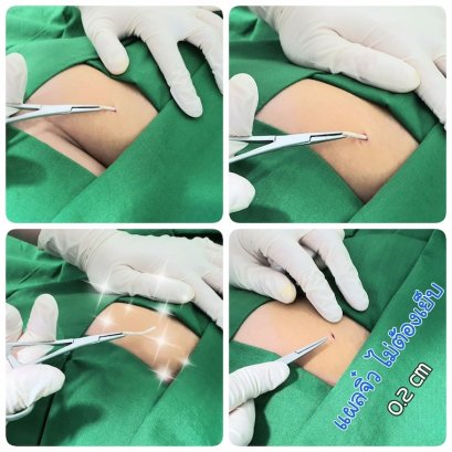 ถอนยาฝังคุมกำเนิด แผลเล็ก ไม่ต้องเย็บ | CMC Wellness