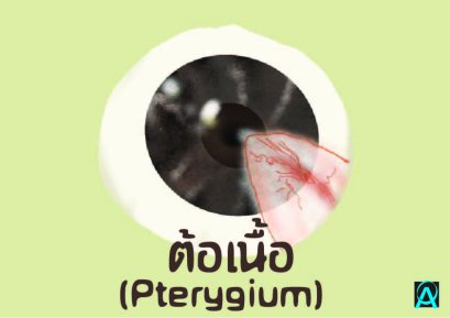 ต้อเนื้อ