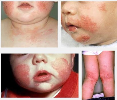 ผื่นภูมิแพ้ผิวหนัง