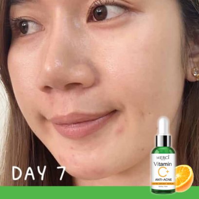 รักษาสิวสูตรเร่งด่วน ด้วย "เมอร์ซี่วิตซี เซรั่มลดสิว"