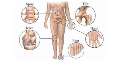 ข้อเข่าเสื่อม