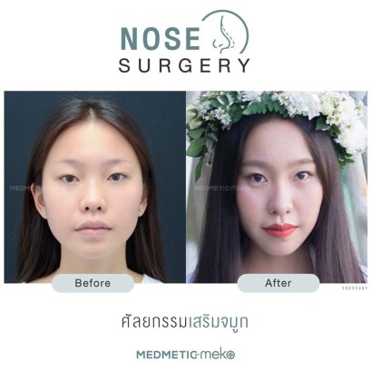 โปรโมชั่น เสริมจมูก Medmetic by Meko