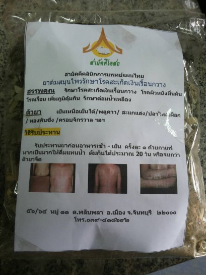 ยาต้มสมุนไพรรักษาโรคสะเก็ดเงินเรื้อนกวาง