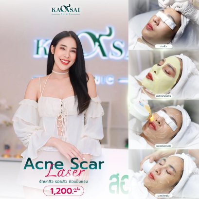 Acne Scar Laser