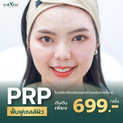 ผิวสวยหน้าฟูด้วยเกร็ดเลือด PRP