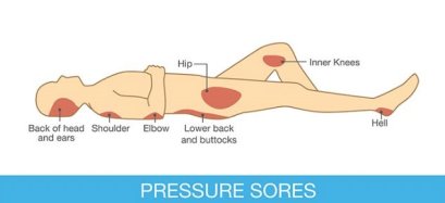 การเลือกซื้อที่นอนป้องกันแผลกดทับ