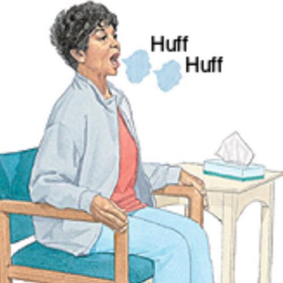 การจัดการปัญหาการคั่งค้างของเสมหะ (management of sputum retention)