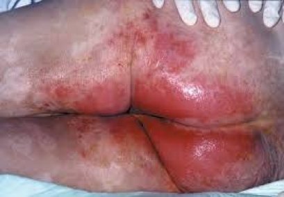 แนวทางปฎิบัติเพื่อป้องกันแผลกดทับ (Incontinence Skin Care)