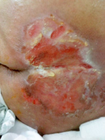 การดูแลผู้ป่วยแผลเรื้อรัง แผลกดทับ แผลเบาหวาน