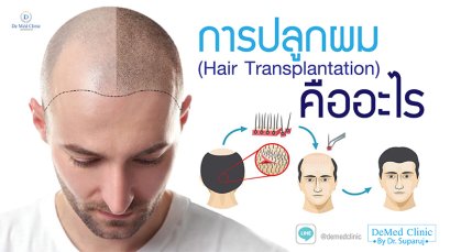 การปลูกผม (Hair Transplantation) คืออะไร