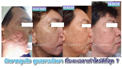 รักษาหลุมสิว ดูผลการรักษา ที่ระยะเวลาเท่าไหร่ดีที่สุด ?
