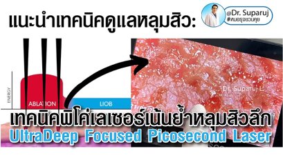 แนะนำเทคนิคดูแลหลุมสิว: เทคนิคพิโค่เลเซอร์เน้นย้ำหลุมสิวลึก UltraDeep Focused Picosecond Laser