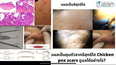 แผลเป็นยุบตัวจากอีสุกอีใส Chicken pox scars ดูแลได้อย่างไร ?