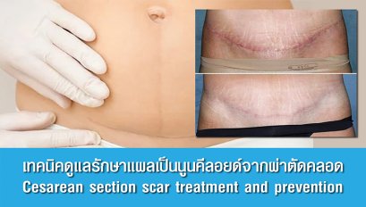 เทคนิคดูแลรักษาแผลเป็นนูนคีลอยด์จากผ่าตัดคลอด Cesarean section scar treatment and prevention