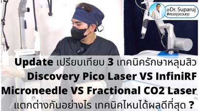 Update เปรียบเทียบ 3 เทคนิครักษาหลุมสิว Discovery Pico Laser VS InfiniRF Microneedle VS Fractional CO2 Laser แตกต่างกันอย่างไร เทคนิคไหนได้ผลดีที่สุด ?