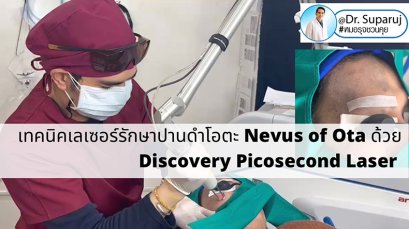 เทคนิคเลเซอร์รักษาปานดำโอตะ Nevus of Ota ด้วย Discovery Picosecond Laser เลเซอร์ปานดำ l หมอรุจชวนคุย