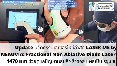 Update นวัตกรรมเลเซอร์ใหม่ล่าสุด LASER ME by NEAUVIA: Fractional Non Ablative Diode Laser: 1470 nm ช่วยดูแลปัญหาหลุมสิว ริ้วรอย แผลเป็น รูขุมขน
