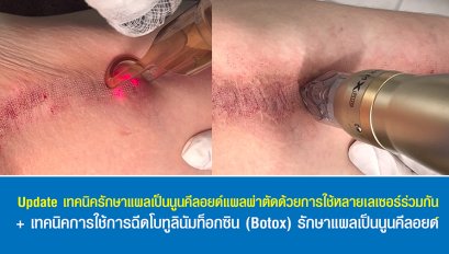 Update เทคนิครักษาแผลเป็นนูนคีลอยด์แผลผ่าตัดด้วยการใช้หลายเลเซอร์ร่วมกัน + เทคนิคการใช้การฉีดโบทูลินัมท็อกซิน (Botox) รักษาแผลเป็นนูนคีลอยด์