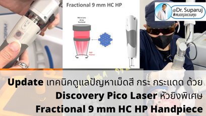 Update เทคนิคดูแลปัญหาเม็ดสี กระ กระแดด ด้วย Discovery Pico Laser หัวยิงเลเซอร์พิเศษ Fractional 9 mm HC HP Handpiece