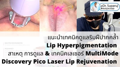 แนะนำเทคนิคดูแลริมฝีปากคล้ำ Lip Hyperpigmentation ริ้วรอย ริ้วรอยรอบริมฝีปาก: สาเหตุ การดูแล & เทคนิคเลเซอร์ MultiMode Discovery Picosecond Laser Lip Rejuvenation