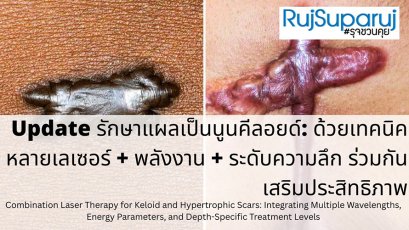 Update รักษาแผลเป็นนูนคีลอยด์: ด้วยเทคนิคหลายเลเซอร์ + พลังงาน + ระดับความลึก ร่วมกันเสริมประสิทธิภาพ Combination Laser Therapy for Keloid and Hypertrophic Scars: Integrating Multiple Wavelengths, Energy Parameters, and Depth-Specific Treatment Level