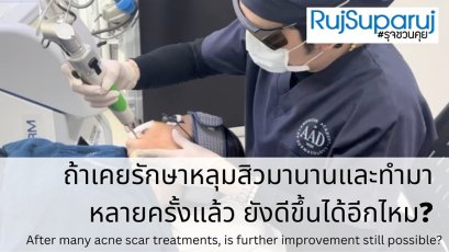 ถ้าเคยรักษาหลุมสิวมานานและทำมาหลายครั้งแล้ว ยังดีขึ้นได้อีกไหม?